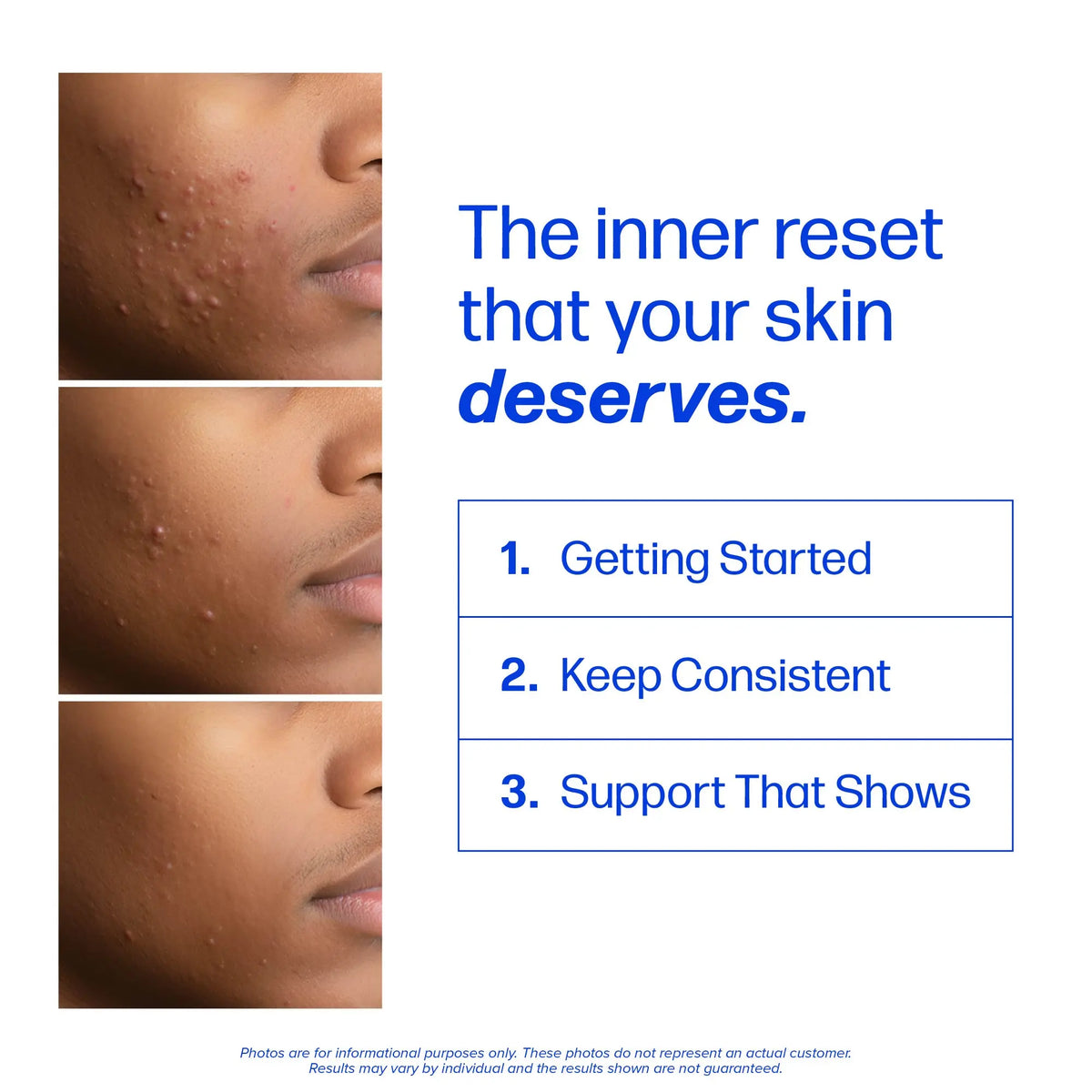 Clear Skin & Acne Support Capsules with Probiotics, DIM & Zinc
