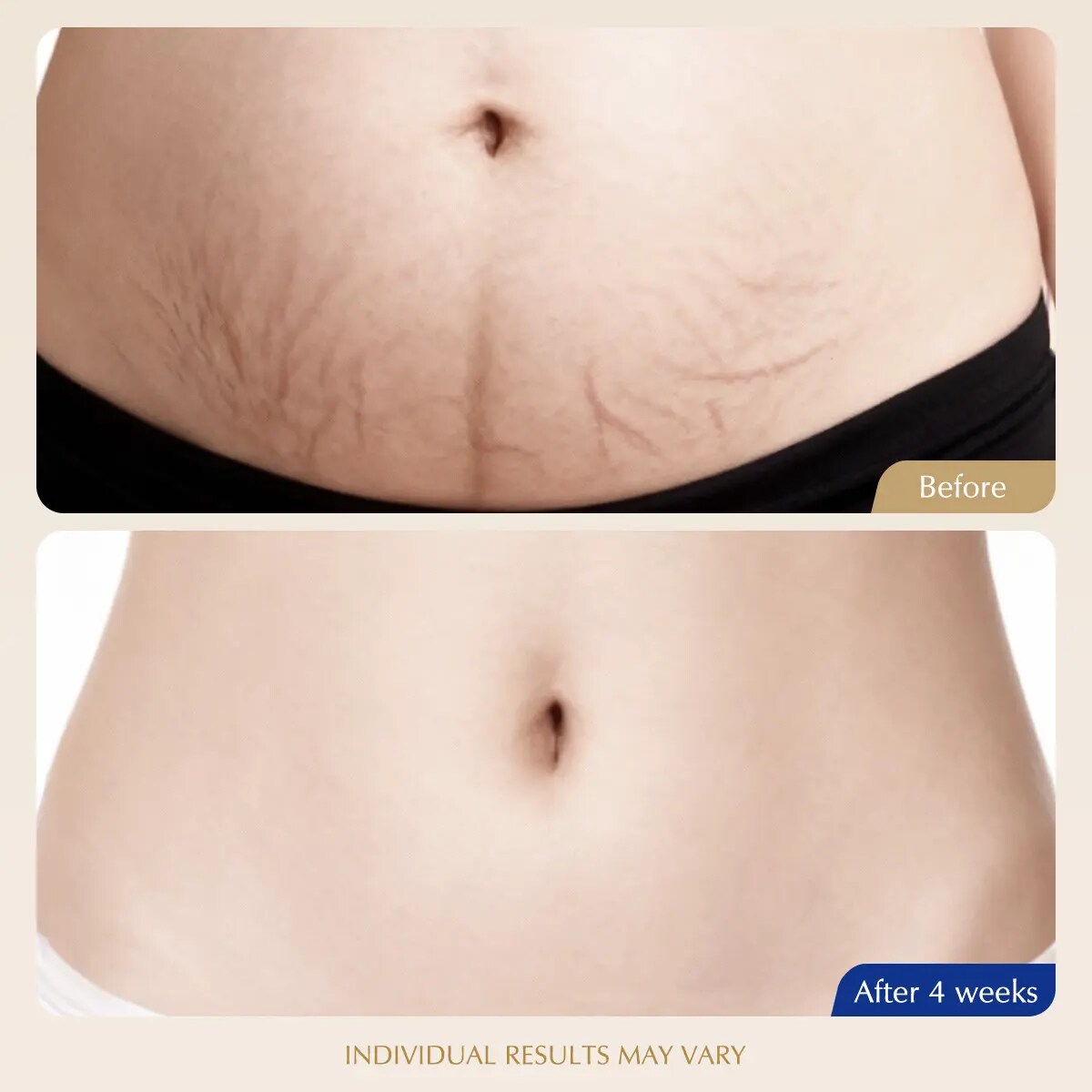 [BUY 1 GET 1 FREE] 15-Day Fast-Acting Cryo-Thermo Gold Sculpting Cream